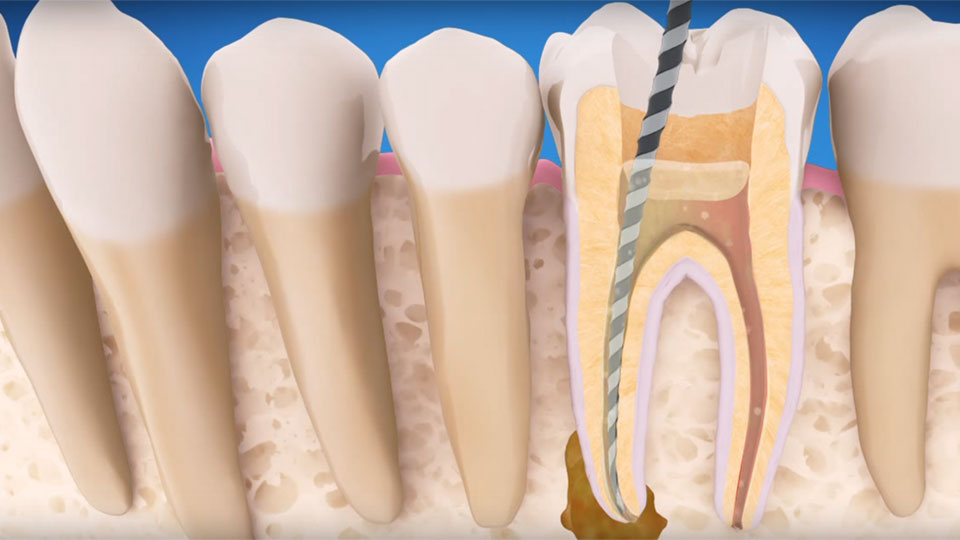 endodontic-treatment